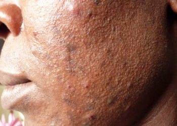 Skin bleaching: causes and complications