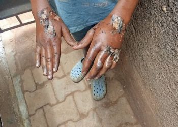 Woman burns 10-year-old with polythene bag over allegedly stealing shs100k