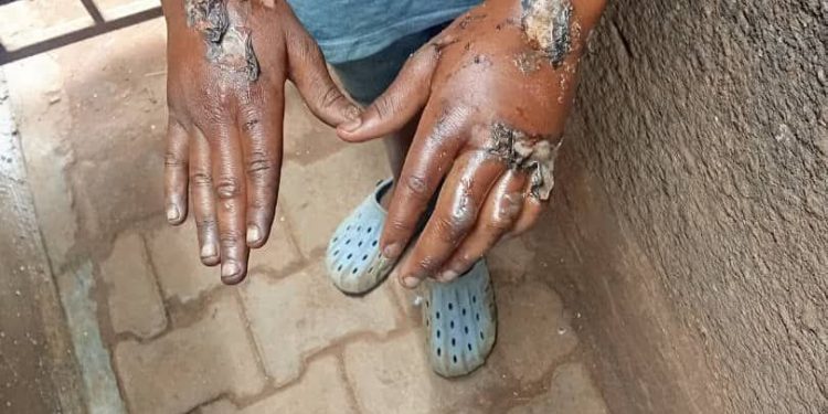 The burnt hands of the child.