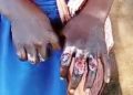 Schoolgirl’s hands burnt over alleged theft of shs1,000