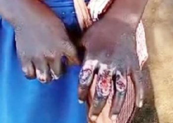 Schoolgirl’s hands burnt over alleged theft of shs1,000