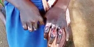 Schoolgirl’s hands burnt over alleged theft of shs1,000